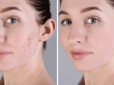 acne-problem-young-woman-before-600nw-2442701427