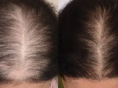 before-after-prp-web